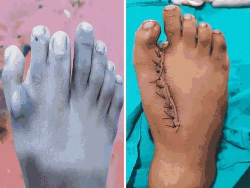 दुर्ग के अस्पताल में 2 चौंकाने वाले केस:बच्चे के पैर में सात उंगलियां,महिला के दायी ओर धड़क रहा था हार्ट; दोनों ऑपरेशन सफल