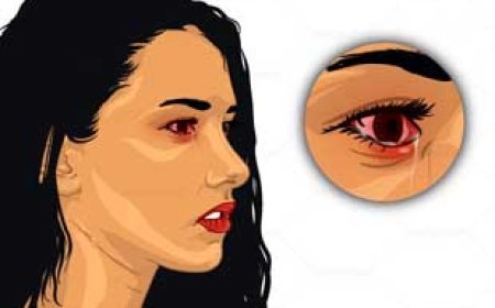 आई फ्लू हो जायेगा गायब,  घर में रखी इन 3 चीजों से धो लें ...