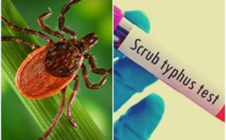 स्‍क्रब टाइफस क्‍या है? रहस्‍यमयी बुखार के कई राज्‍यों में बढ़ रहे केस, क्‍या हैं लक्षण और इलाज