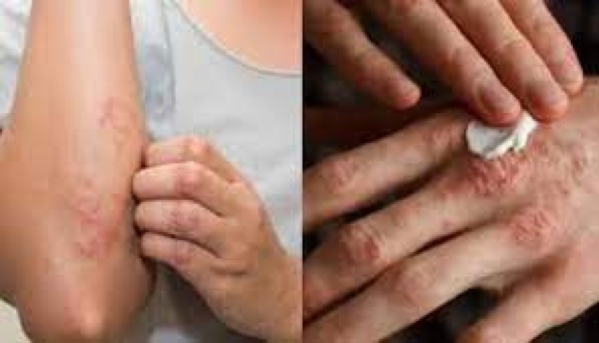 फंगल इंफेक्शन को कभी न समझें मामूली, हर साल इससे होती है 32 लाख की मौत, खुजली भी हो जाती है गंभीर