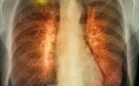 नॉन-स्मोकर्स में भी बढ़ रहा लंग कैंसर का खतरा, डॉक्टरों ने बताए 5 शुरुआती संकेत