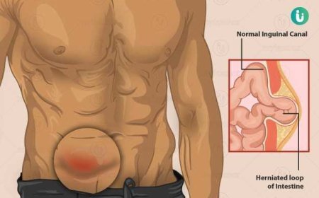 खांसने या भारी सामान उठाने पर पेट में उभार दिखे? इसे मामूली सूजन न समझें, ये हो सकता है हर्निया का संकेत